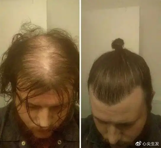 心尖生发脱发的朋友适合哪些发型