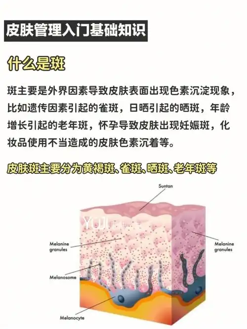 皮肤管理了解斑形成的原因