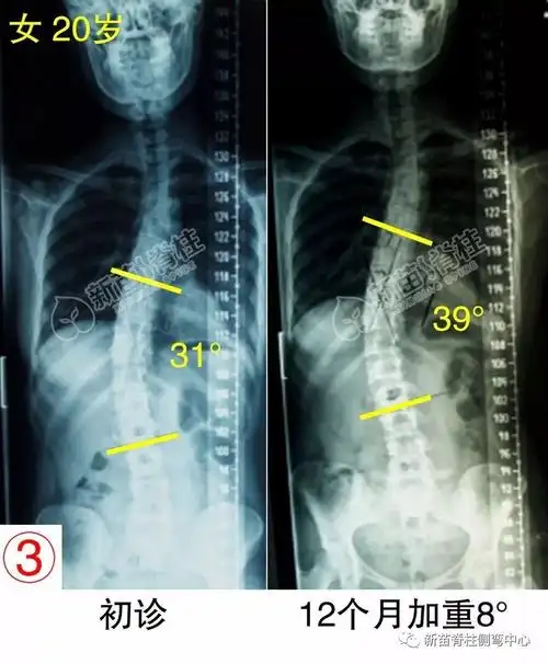 成年人轻度脊柱侧弯没关系事实你还得长点心