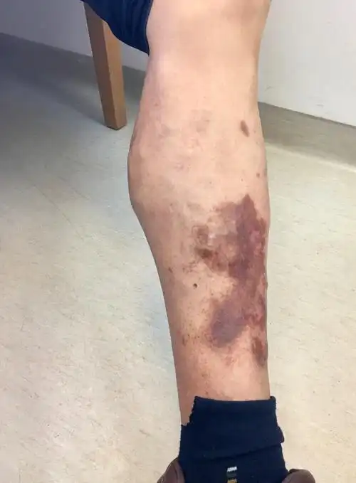 长期的静脉高压导致小腿部位毛细血管通透性增加,红细胞渗出后破裂,铁