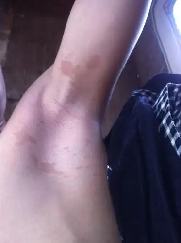 去年夏天长的 腋窝下 两边都有 刚开始是白色 没管它 现在变淡黑色了