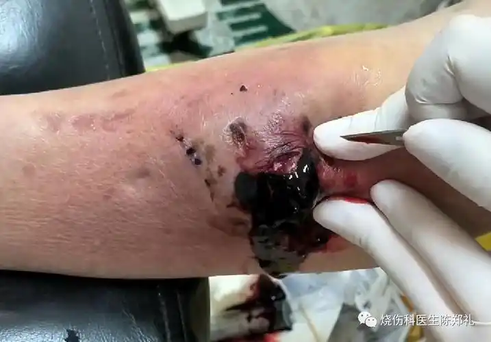 视频| 电瓶车导致的小腿撞伤|烧伤外科|撞伤|血肿|-健康界