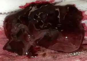 50天自然流产孕囊图片 - 搜狗图片搜索