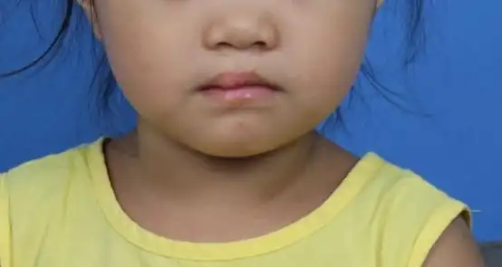 小女孩的父母说,刚出生发现孩子得了唇裂,当时全家人都心灰意冷,不知