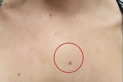 1,寻常疣:寻常疣是由人乳头瘤病毒感染引起的,病毒进入皮肤细胞后,会