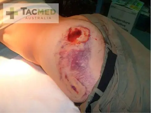 ak-47枪伤照片(别担心,他也没什么大问题).来源:tacmed australia