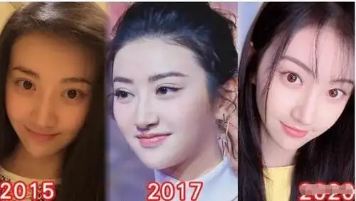 景甜开直播承认整容失败,埋线失败变成青蛙眼,坦言抑郁很久了