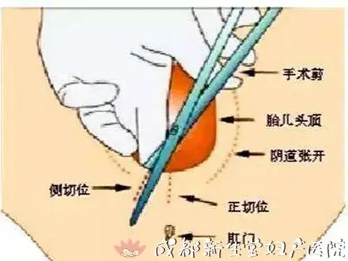 哪些情况需要侧切?侧切与裂伤有什么不同?
