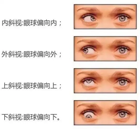 常见的斜视症状如何治疗斜视?