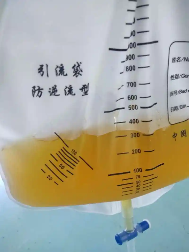 同样都是胸腔积液,为什么它们的颜色不一样?