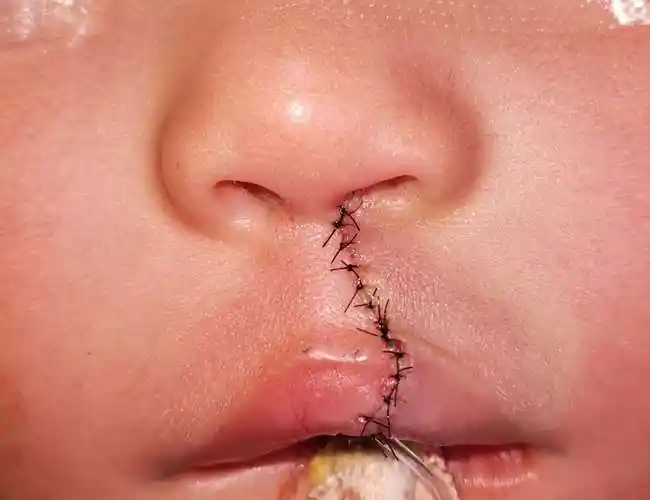 世界微笑日丨南阳微笑列车助唇腭裂宝宝绽放灿烂笑容