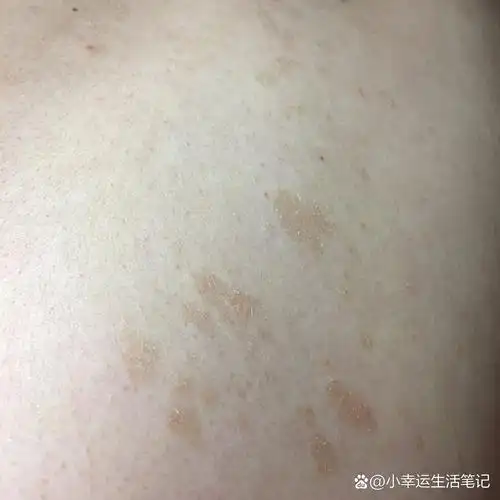 花斑癣(汗斑)&玫瑰糠疹
