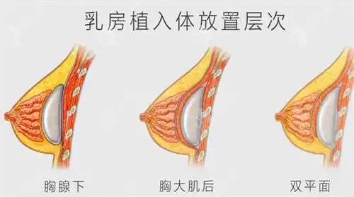成都薛瑞隆胸很厉害嘛68770元做的傲诺拉闪耀隆胸确实如此
