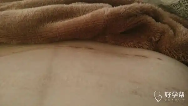 剖腹产这个伤口什么时候能恢复啊