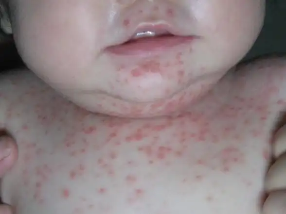 新生儿牛皮癣病因是什么