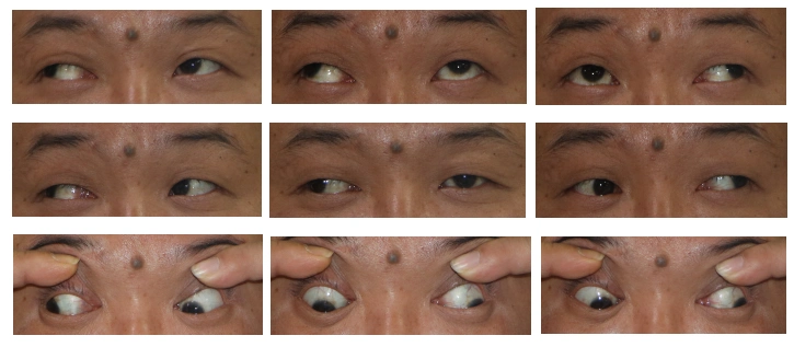 外斜视案例 - 好大夫在线