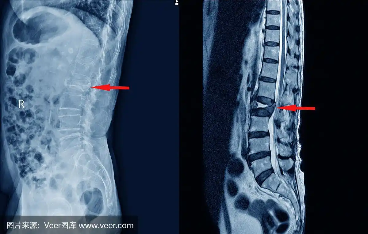 医用x线腰椎压缩性骨折l1-2膨出.