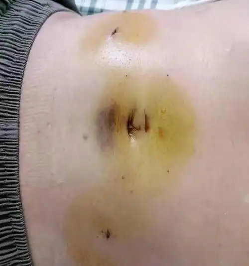 我院胃肠肝胆外科迈入微创精准新时代