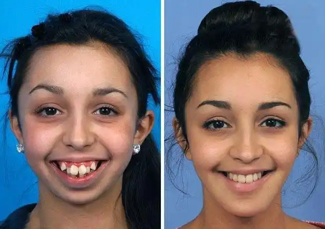 满口龅牙被人嘲笑为"丑女",整容后变成美女,被无数男生追求