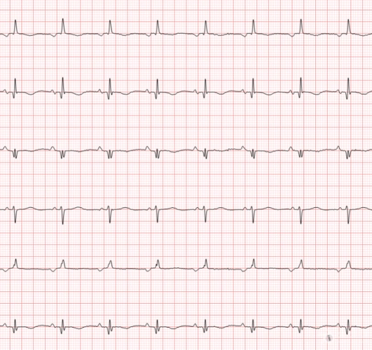 冬秋心电图讨论20170423i导联p波倒置