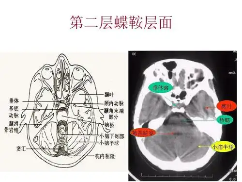 颅脑基本病变的ct诊断ppt