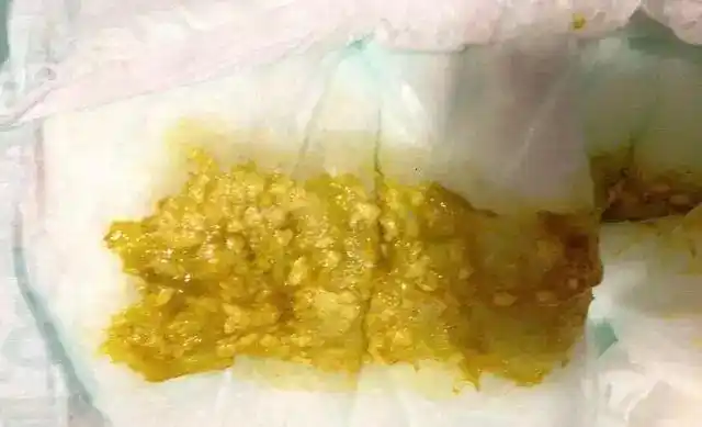 其实就是没有消化掉的脂肪.