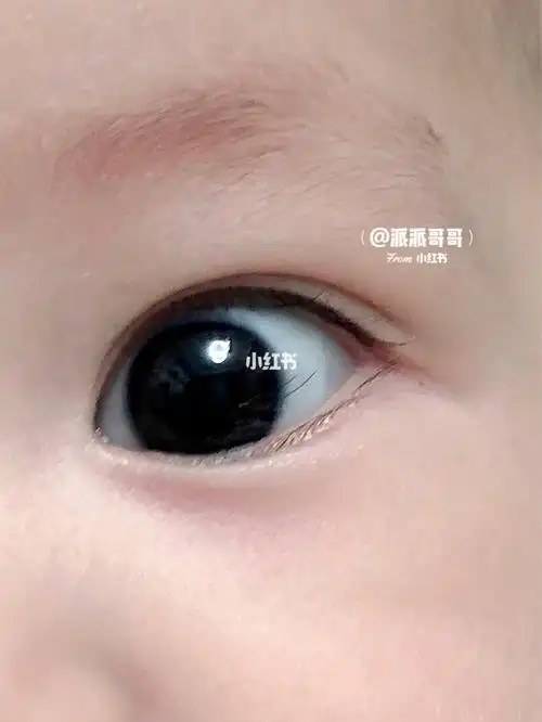 求助宝宝眼睛里进睫毛了还是两根