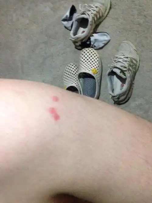 这都什么虫子咬的,那么毒,好几天了都