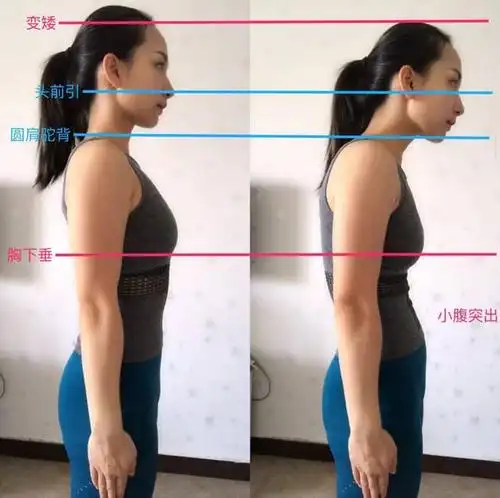 长时间低头玩手机 还喜欢跷二郎腿 多会有脖子前伸 圆肩驼背 脊椎侧弯