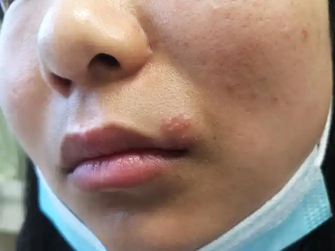 单纯疱疹怎么来的