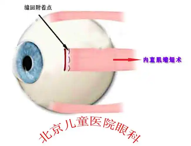 斜视手术示意图——北京儿童医院眼科