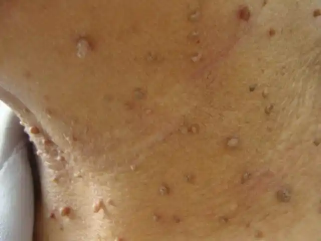 软纤维瘤伴发指状疣