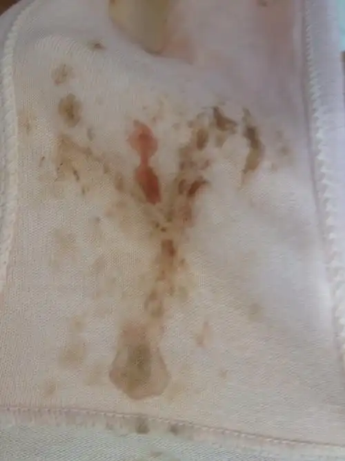 怀孕五个月,内裤上有血迹求解