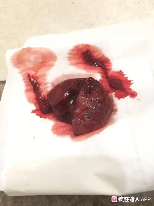 记录自然流产经历,有图怀孕妈妈慎入!