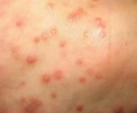 【图】皮肤癌早期症状是什么 皮肤癌能治好吗 皮肤癌的治疗方法