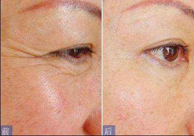 眼周鱼尾纹怎么去除比较好【昆明华美美莱】