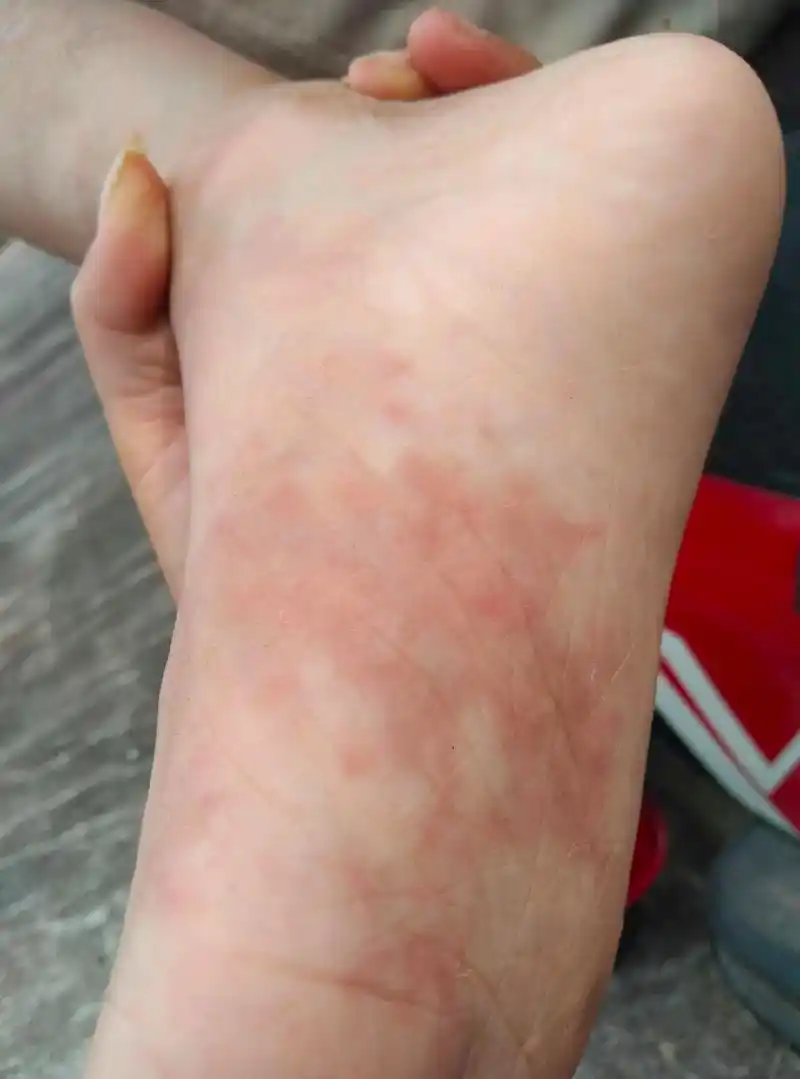孩子就是因为前年打了新冠导致脚长斑又红又肿!