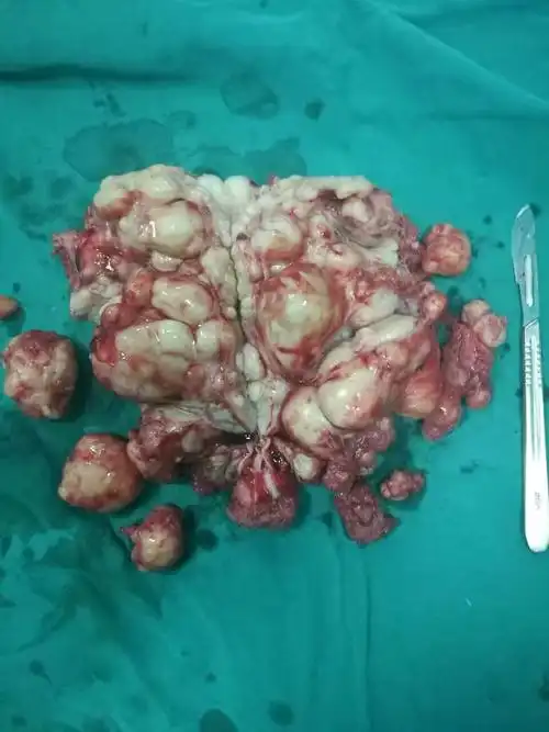 子宫肌瘤 - 好大夫在线