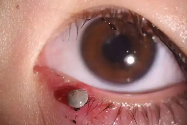 恐怖!7岁幼儿眼睛里,居然钻进去这样一个虫子