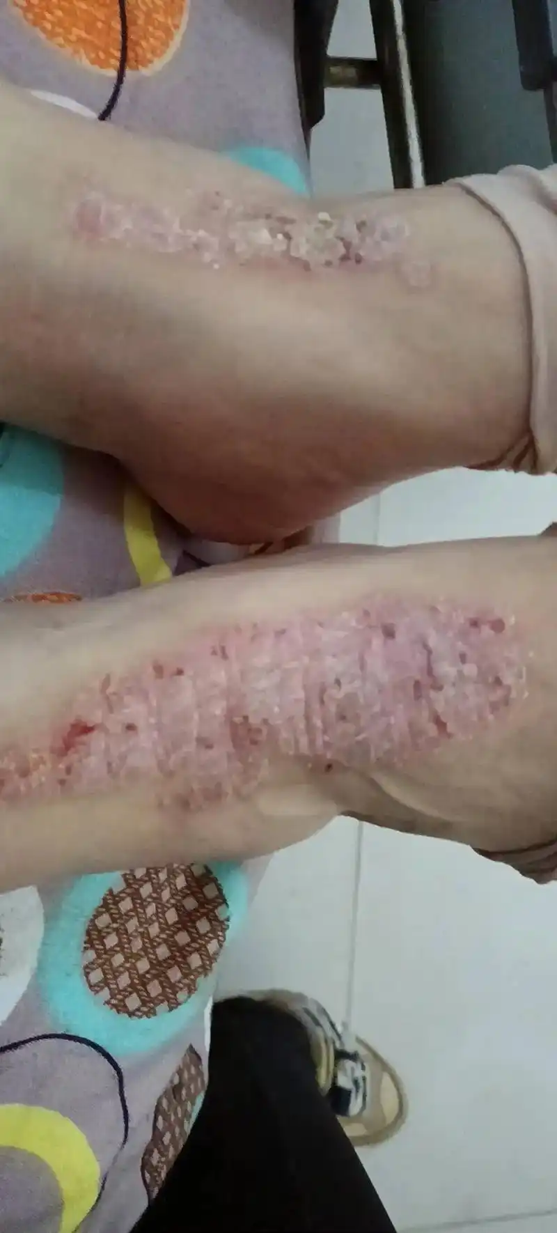 万能的抖友,菏泽附近哪里有看皮肤病的,妈妈胳膊上