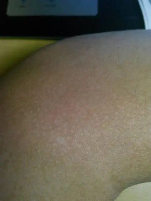 皮肤上莫名其妙起这样的小白点,这是什么东西?