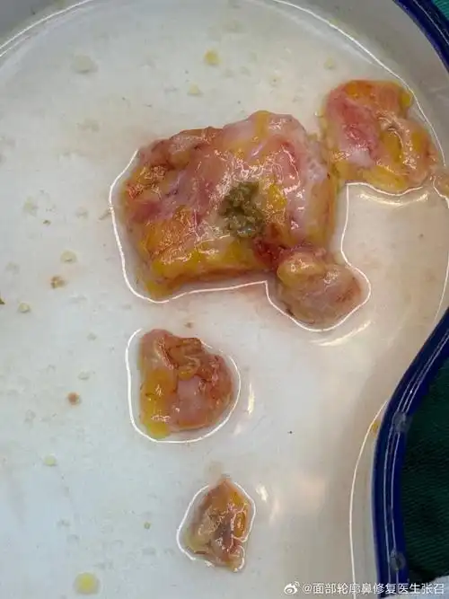 取乳房注射物#两年前自体脂肪注射丰胸,后来脂肪液化,感染发烧,保守