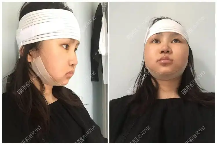 今天是术后一个月在韩国da整形医院做了两颚手术