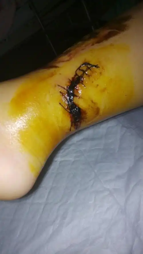 我女儿三岁5,13日受伤腿部撕裂伤肌肉受伤缝合三层九针,小腿前部严重