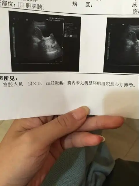 你们怀孕45天b超宝宝长的多大了