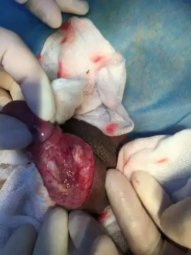 今天做包皮手术,割开后有黄色白色的东西,手术大夫说是硬性淋巴管发炎