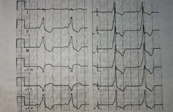 a型wpw综合征心电图