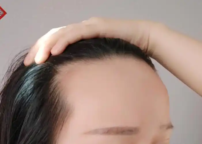 植发际线第四天