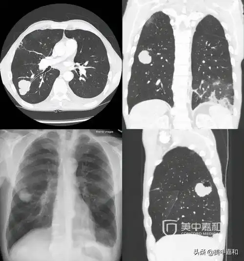 确诊后必须了解的6个问题,让肺癌治疗少走弯路