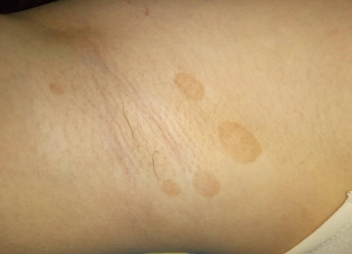 【汗斑图片】_表现症状_怎么治疗_苹果绿